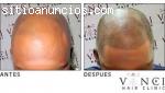 Alopecia tratamiento  con micropigmentac