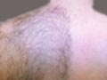 Depilacion Laser Malaga Centros de estetica y fotodepilacion masculina 