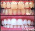 Kit BlanqueadorDientes Profesional