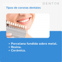 Implantes dentales en Tijuana - DENTOK M