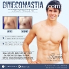 Ginecomastia